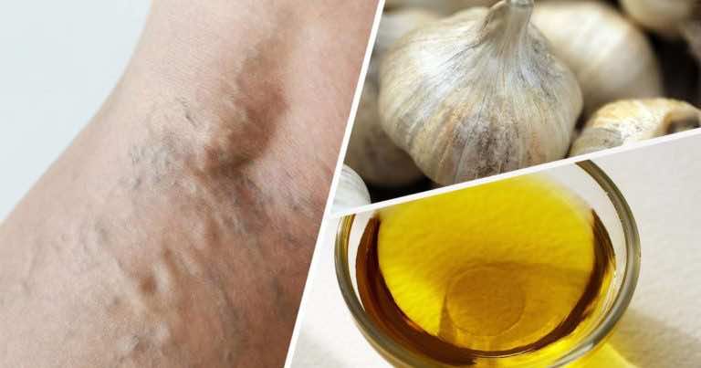 Pożegnaj żylaki wykorzystując ten domowy sposób