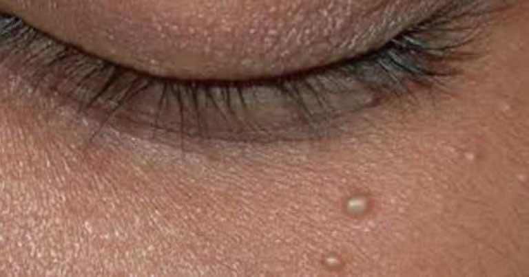 Masz problem z takimi białymi krostkami na skórze? Zobacz jak się ich pozbyć!