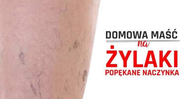 Przepis na domową maść na żylaki i popękane naczynka