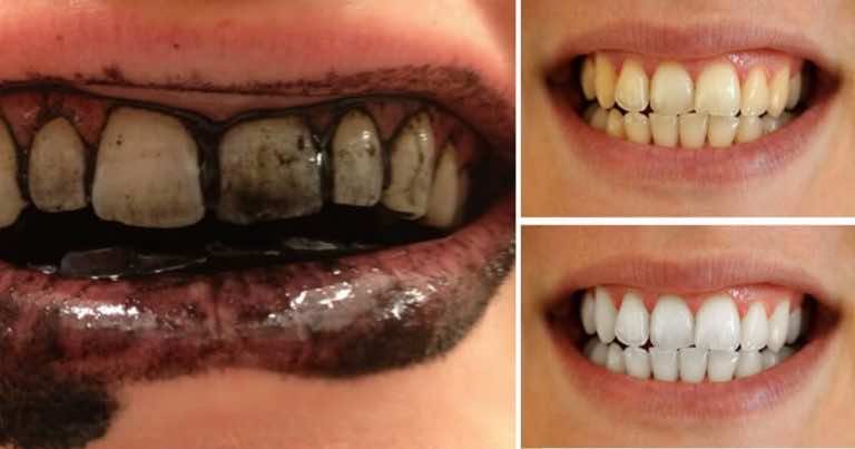 Wybielająca pasta do zębów na bazie węgla aktywnego – przepis