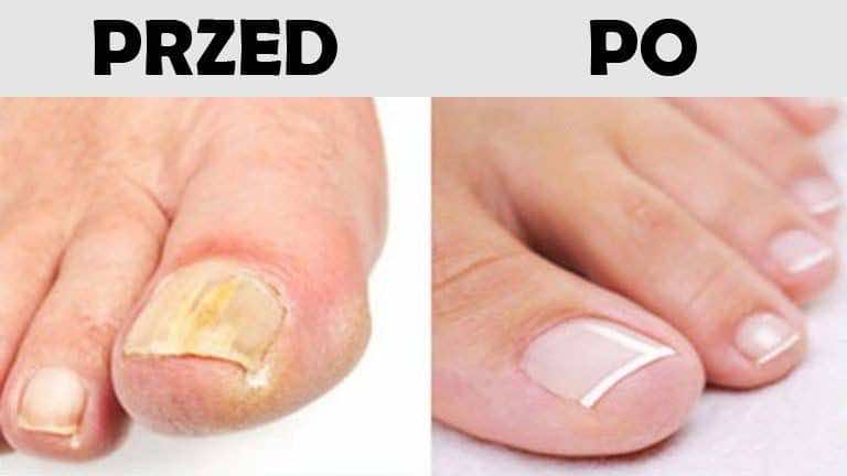 Domowy sposób na grzybicę paznokci