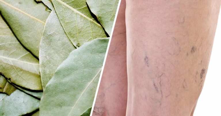 Liście laurowe to sposób na żylaki