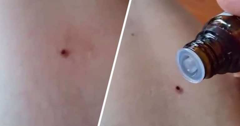 Olejek miętowy na kleszcza? Uważajcie na tę „dobrą radę”!