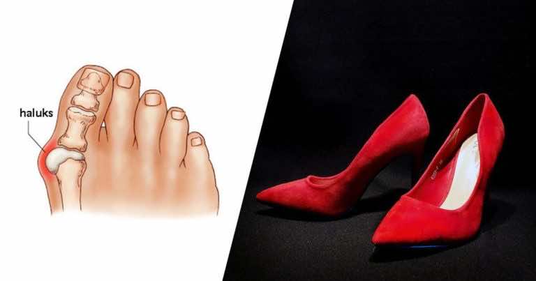 Jeśli masz haluksy zobacz jakie buty powinnaś nosić
