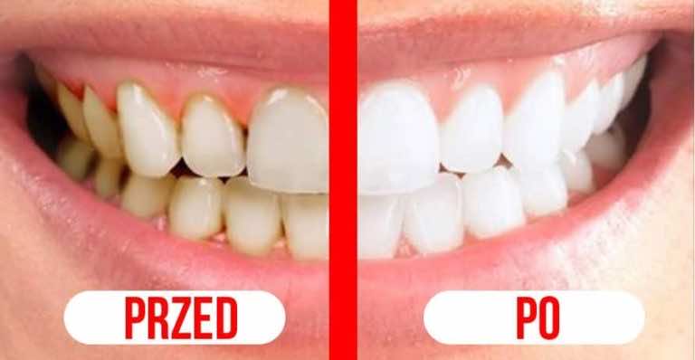 Chcesz mieć wreszcie biały uśmiech? Wypróbuj ten domowy sposób.