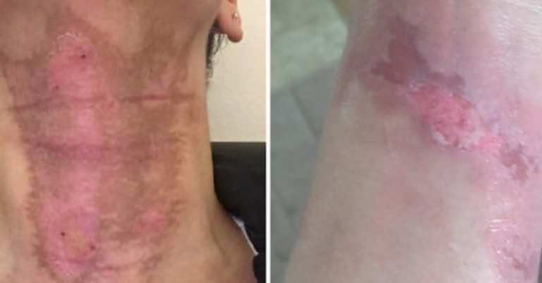 Uważajcie na olejki, które nakładacie na skórę. Podczas opalania mogą powodować poparzenia!