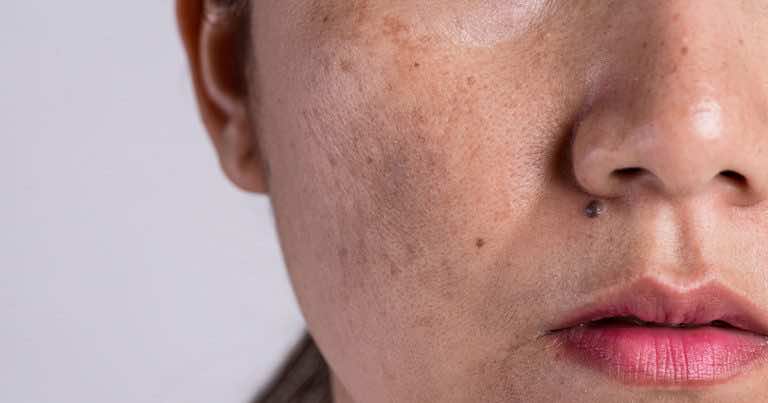 Jak pozbyć się przebarwień na skórze