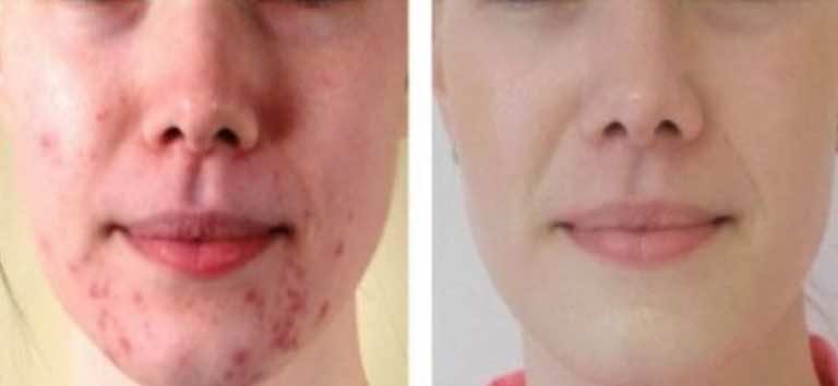 Nałóż to na blizny, zmarszczki czy plamy na skórze i obserwuj jak znikają.