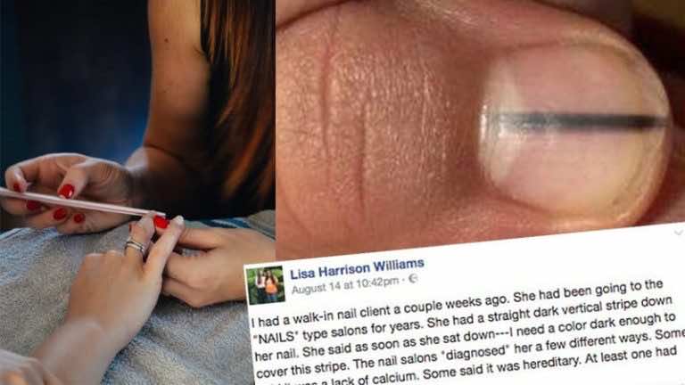 Kosmetyczka zobaczyła jej paznokcie i wysłała ją do lekarza. To uratowało jej życie!