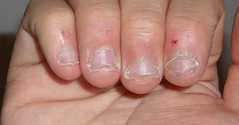 Czy wiesz dlaczego ludzie obgryzają paznokcie? Powód jest ciekawy!
