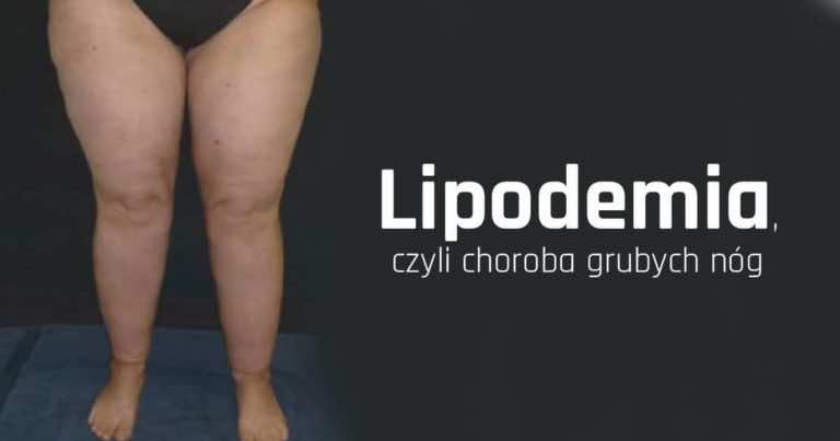 Grube nogi mogą być objawem choroby! Lipodemia, czyli choroba grubych nóg.