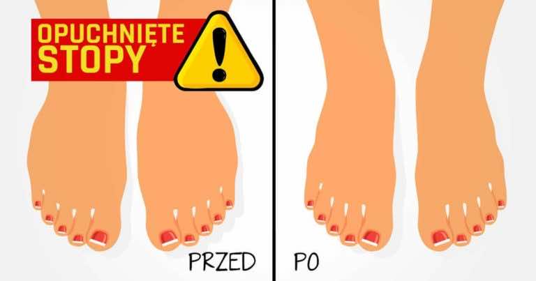 Domowe sposoby na opuchnięte stopy