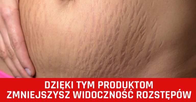 6 produktów, które pomogą Ci zmniejszyć widoczność rozstępów