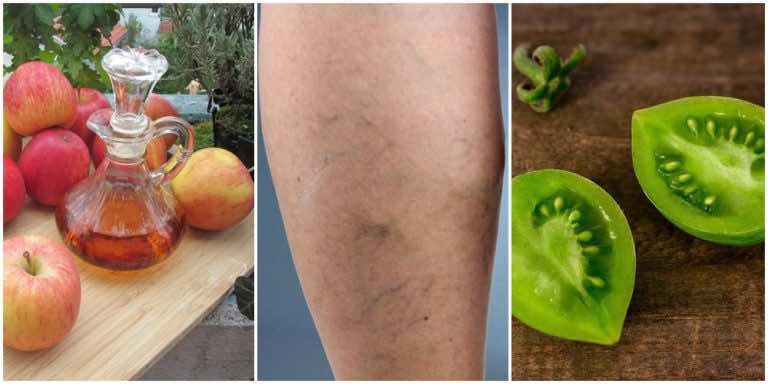 Żylaki na nogach – zobacz jak z nimi walczyć domowymi metodami