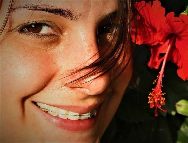 Aparat ortodontyczny – Czy warto go założyć?