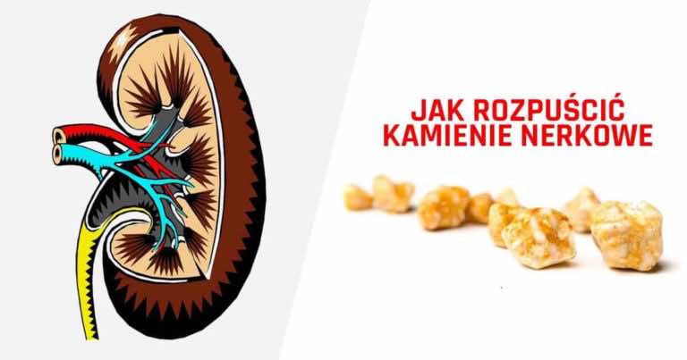 Jak rozpuścić kamienie nerkowe – DOMOWY SPOSÓB