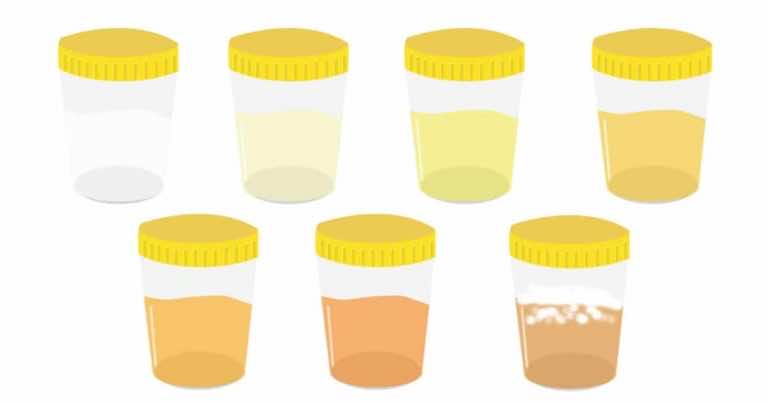 Kolor moczu – co oznacza i o czym nas informuje?