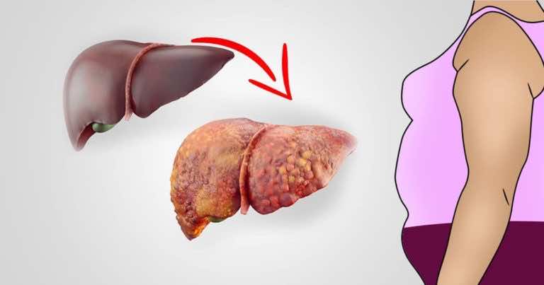 6 sygnałów ostrzegawczych, że Twoja wątroba jest pełna toksyn