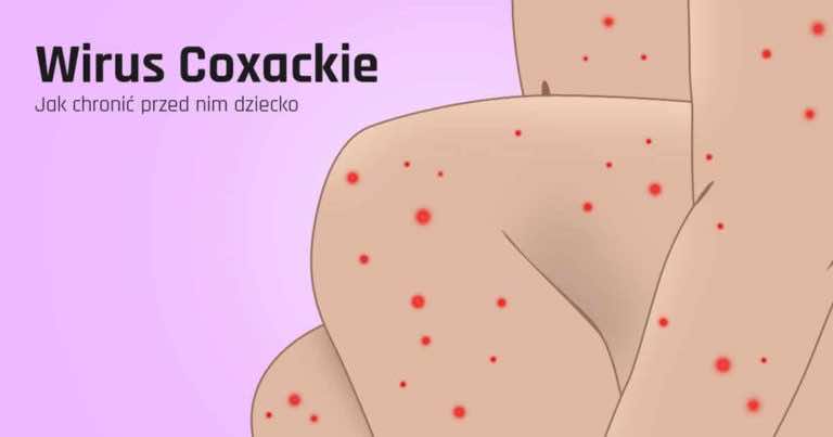 Wirus Coxackie co to jest i jak chronić nasze dziecko