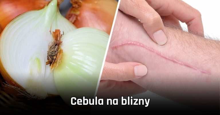 Cebula na blizny – jak zmniejszyć widoczność blizn