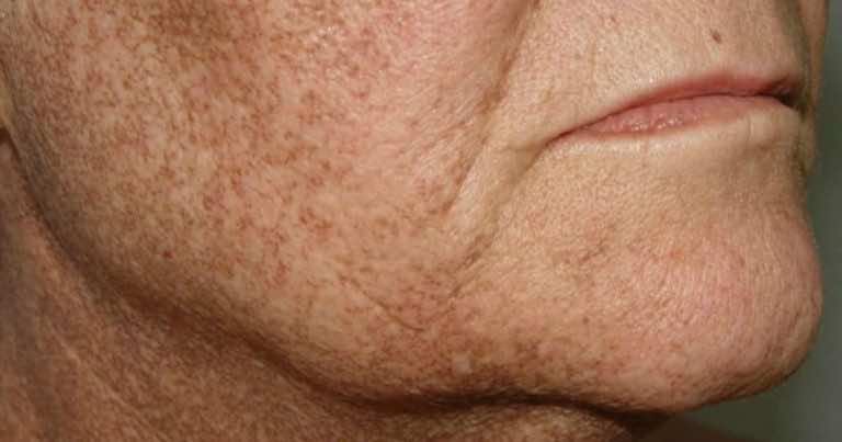 Rozwiąż problemy związane z przebarwieniami skóry tymi naturalnymi lekami