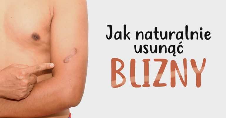 Jak naturalnie usunąć BLIZNY