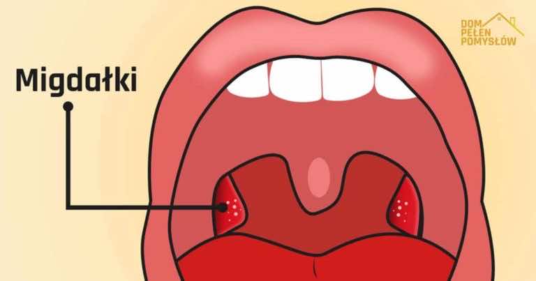 5 objawów zapalenia migdałków, których nie możesz ignorować