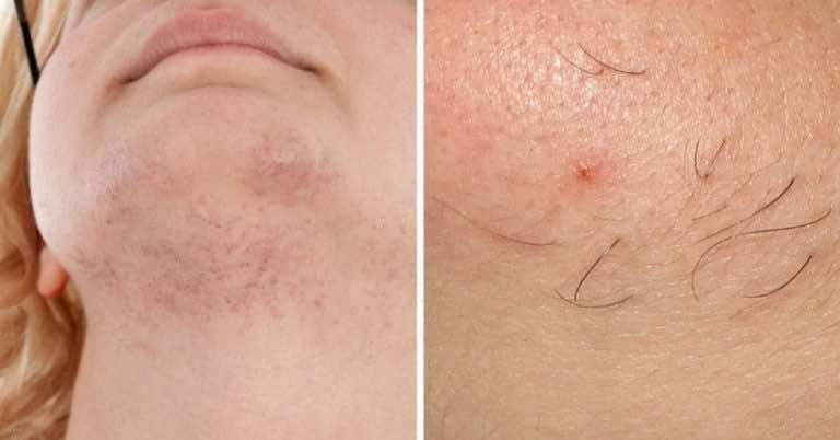 Włoski na brodzie? Oto kilka powodów przez, które możesz je mieć.