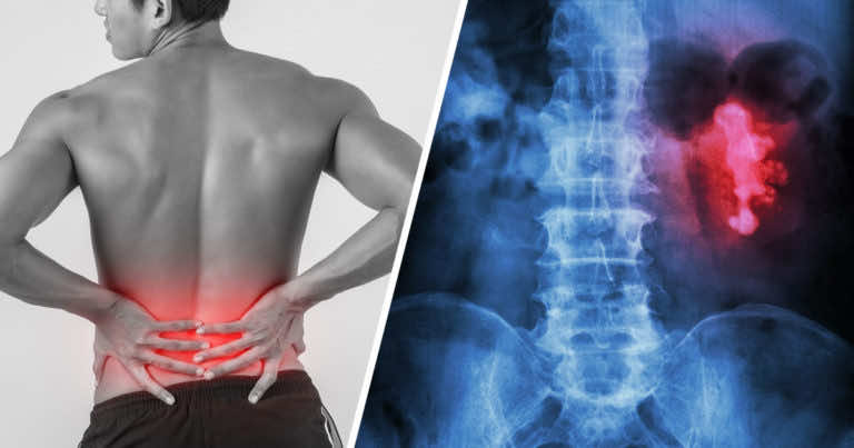 Co roku 2,5 tysiąca osób umiera na raka nerki, a badanie, które go wykryje jest bezbolesne!