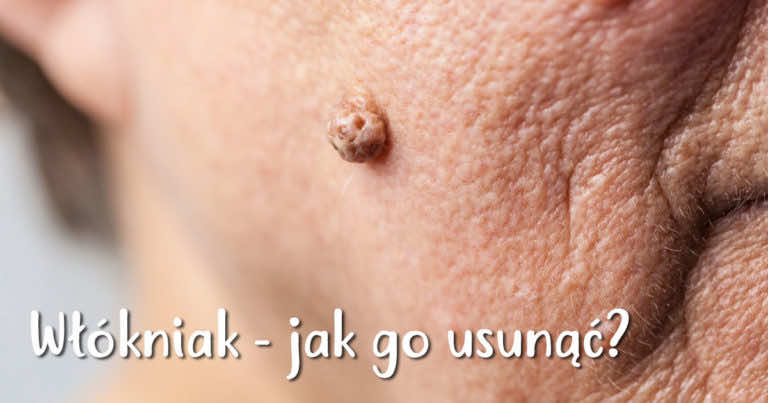 Włókniak (fibroma) jak go usunąć i czy należy się nim martwić?