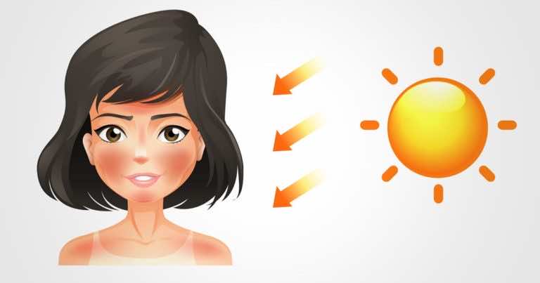 6 wskazówek, które ochronią Cię przed oparzeniami słonecznymi w ciągu wakacji