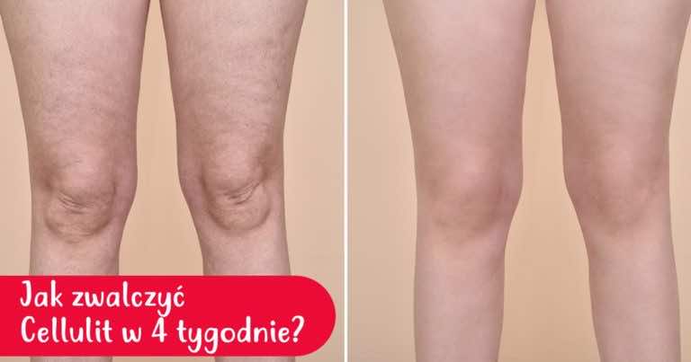 Jak zwalczyć cellulit w domu w 4 TYGODNIE