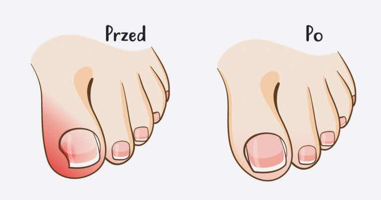 Domowy sposób na wrośnięty paznokieć