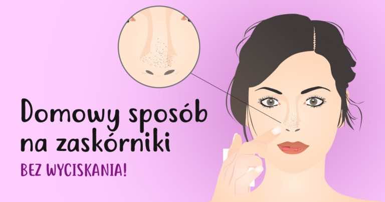 Jak usunąć zaskórniki bez wyciskania