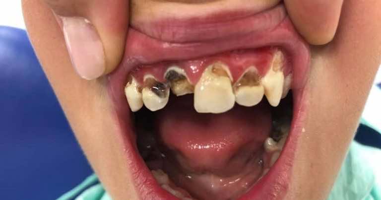 Tak wyglądają zęby 12 latka, który „sam” od urodzenia mył zęby!