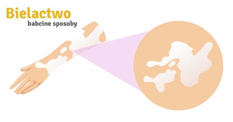 4 babcine sposoby na pozbycie się bielactwa nabytego