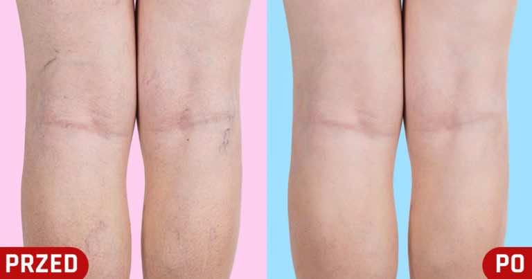 Tych trzech metod na pozbycie się żylaków na pewno jeszcze nie próbowałaś!