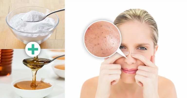 Sposób na zaskórniki – soda oczyszczona i miód