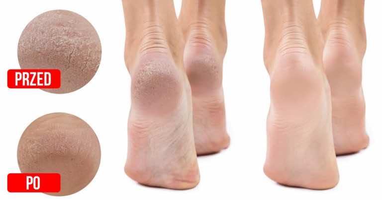 Jak zmiękczyć skórę na stopach