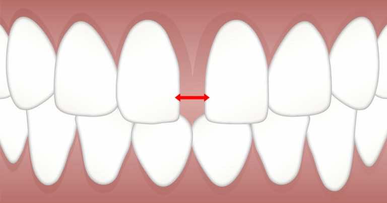 Masz diastemę? Zobacz co mówi to o Twojej osobowości!