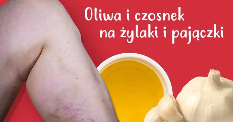 Oliwa z oliwek i czosnek to sposób na żylaki, który musisz wypróbować!