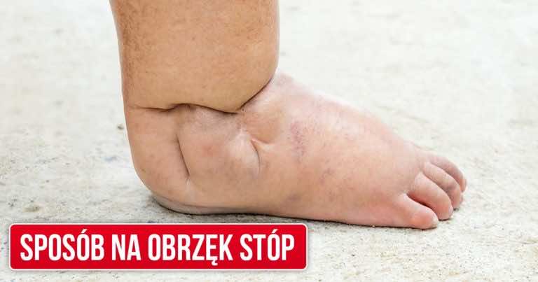 Najlepszy domowy sposób na spuchnięte stopy