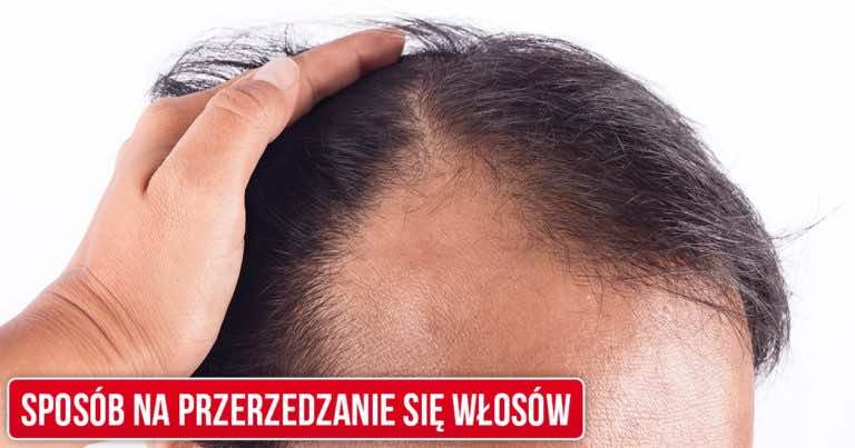 Twoje włosy zaczęły się przerzedzać? Zacznij codziennie to brać by opóźnić proces łysienia!