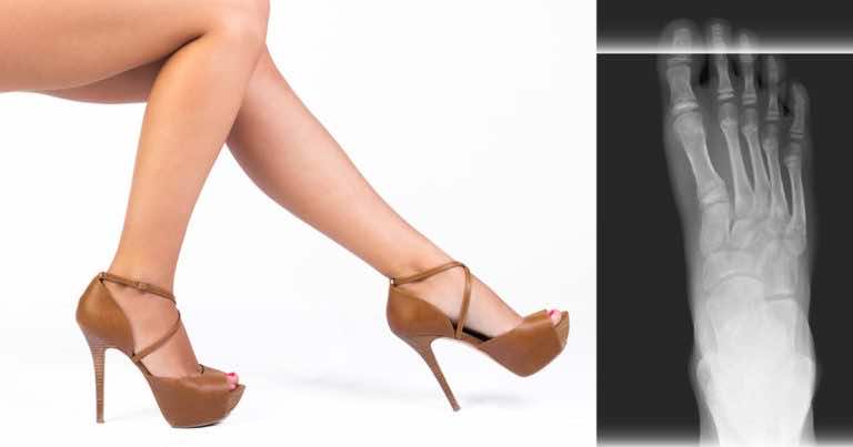 Zobacz dlaczego chodzenie na obcasach jest niezdrowe!