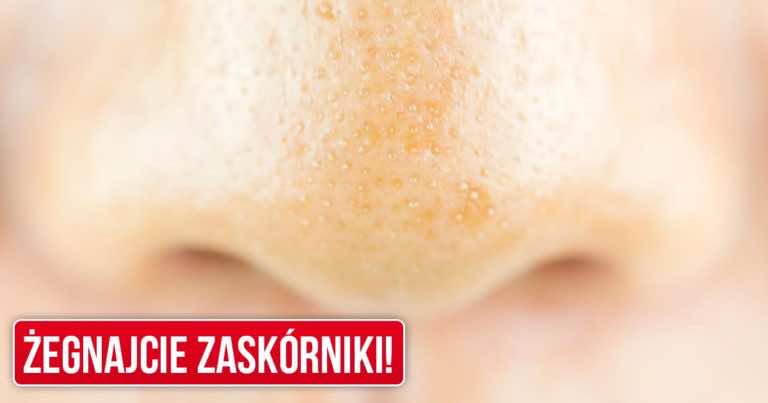 Pogromca zaskórników – maseczka z produktów, które masz w domu