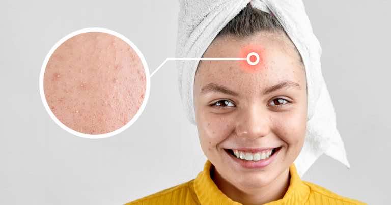 Przepis na domową maseczkę na zaskórniki