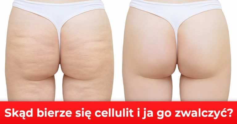 Skąd bierze się cellulit? Sposoby na usunięcie cellulitu.
