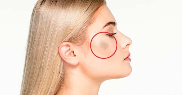 Zauważyłaś na swoim policzku takie przebarwienie? Zobacz co to!