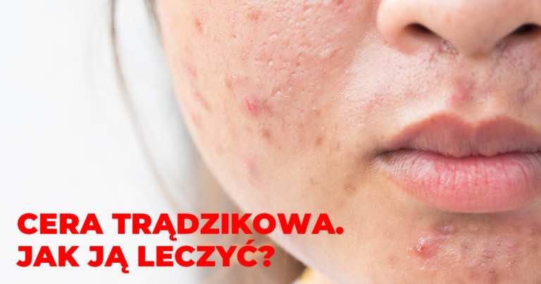 Cera trądzikowa – jak ją leczyć