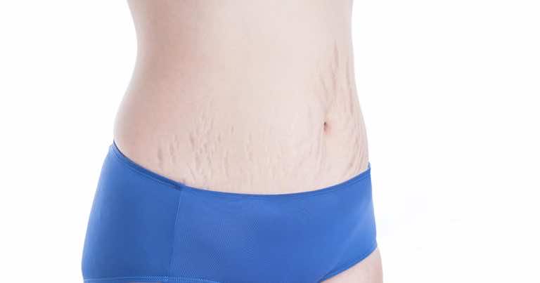 Domowy peeling na rozstępy